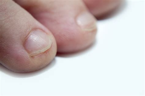 Cu diabetul, unghiile de la picioare sunt afectate